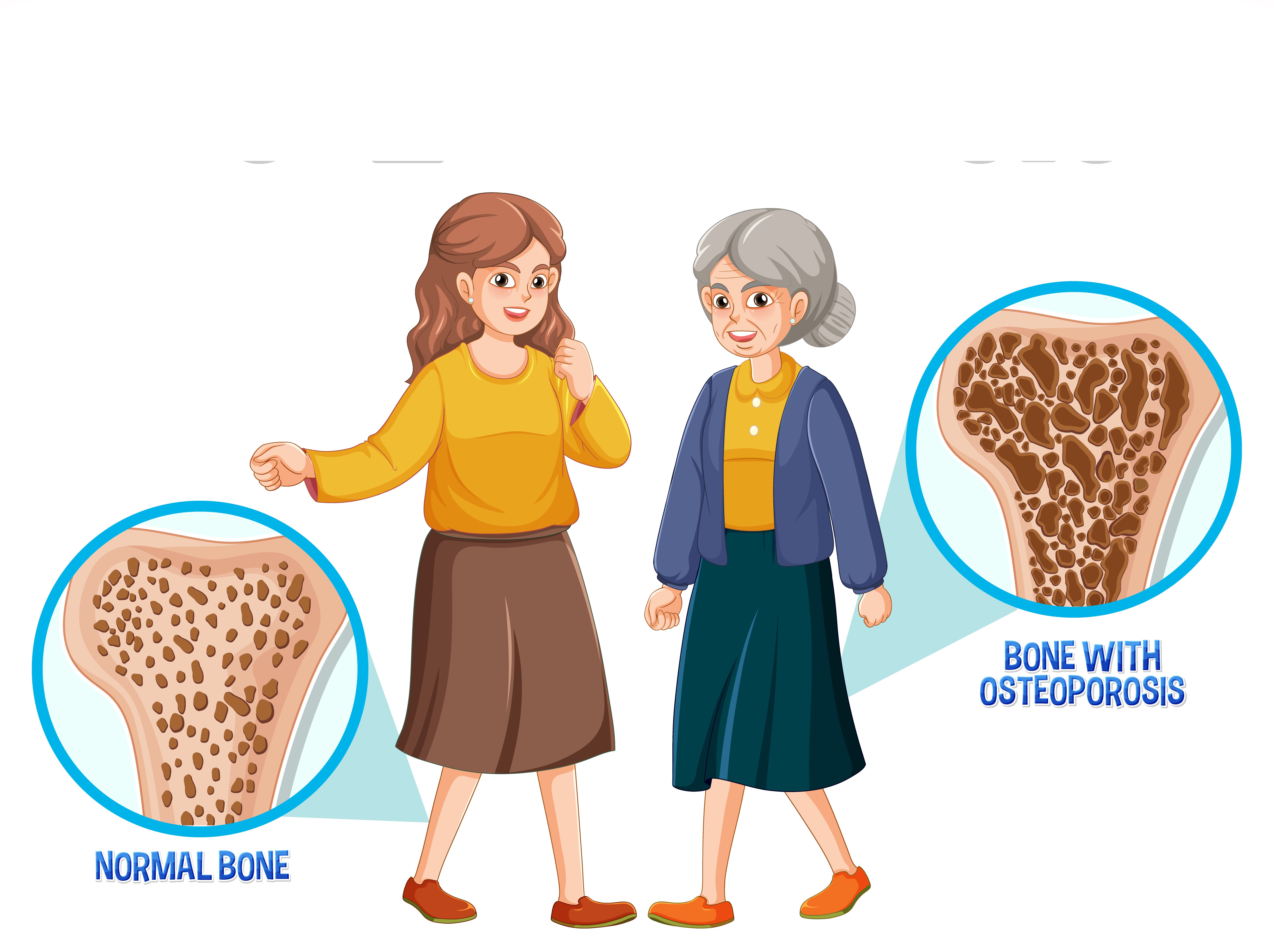 Osteoporosis