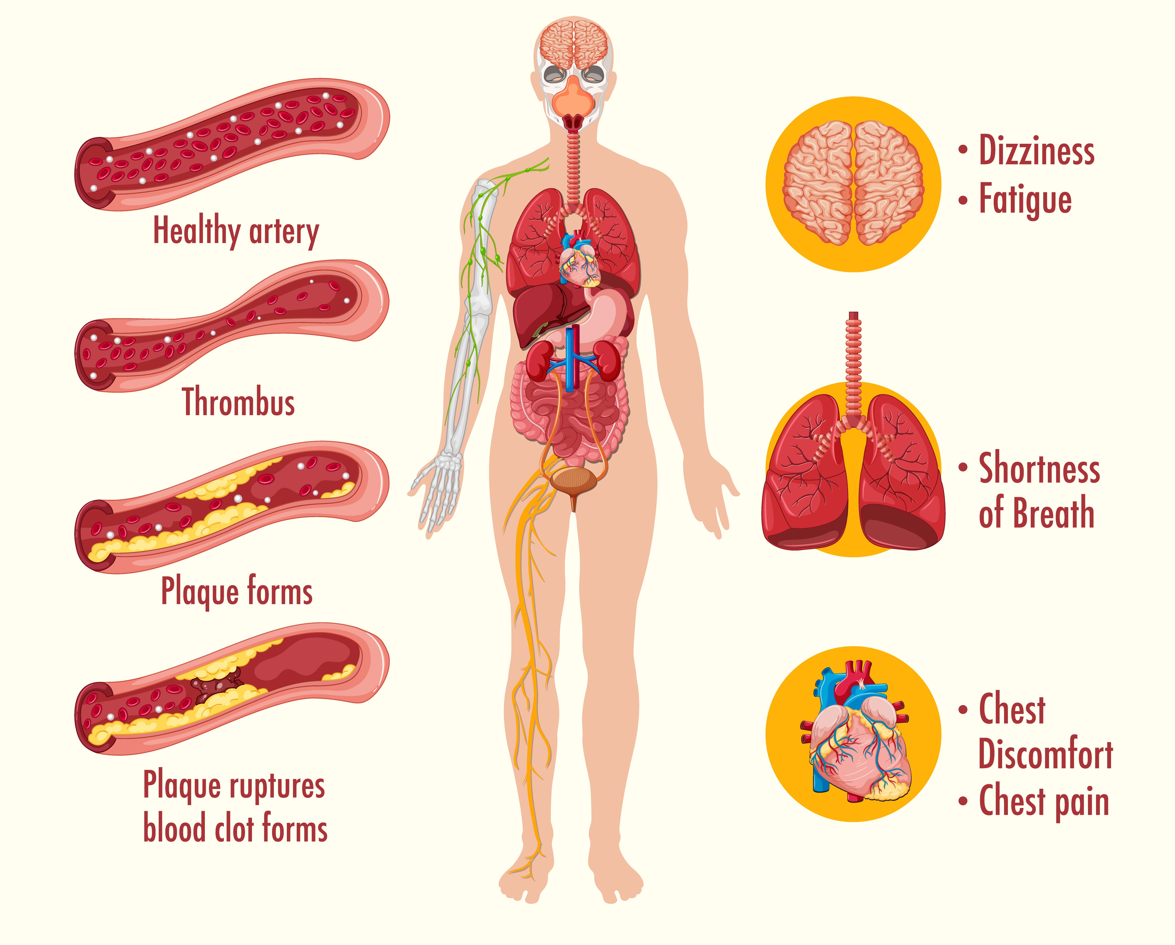 Vasculitis