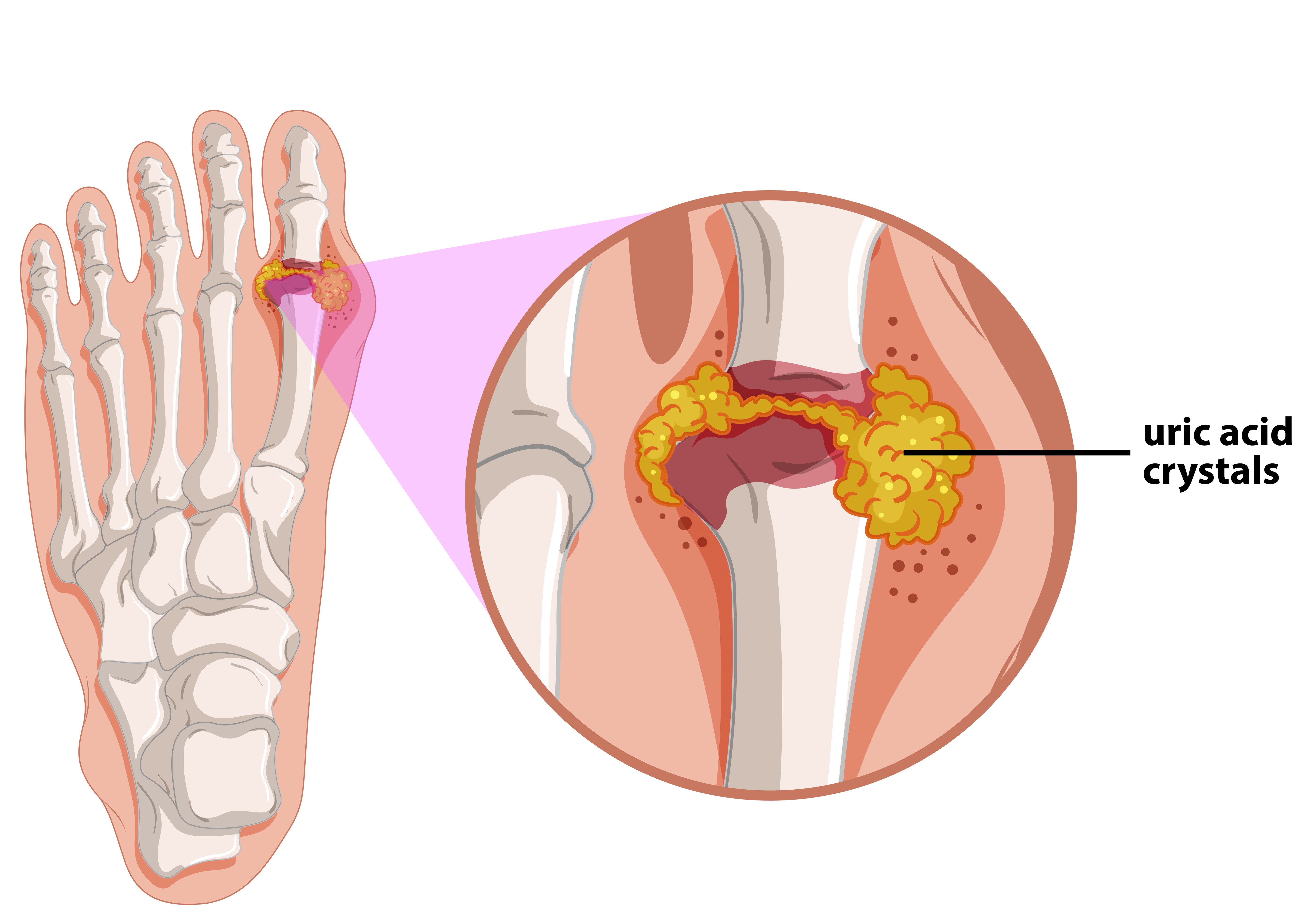 Gout and High Uric Acid