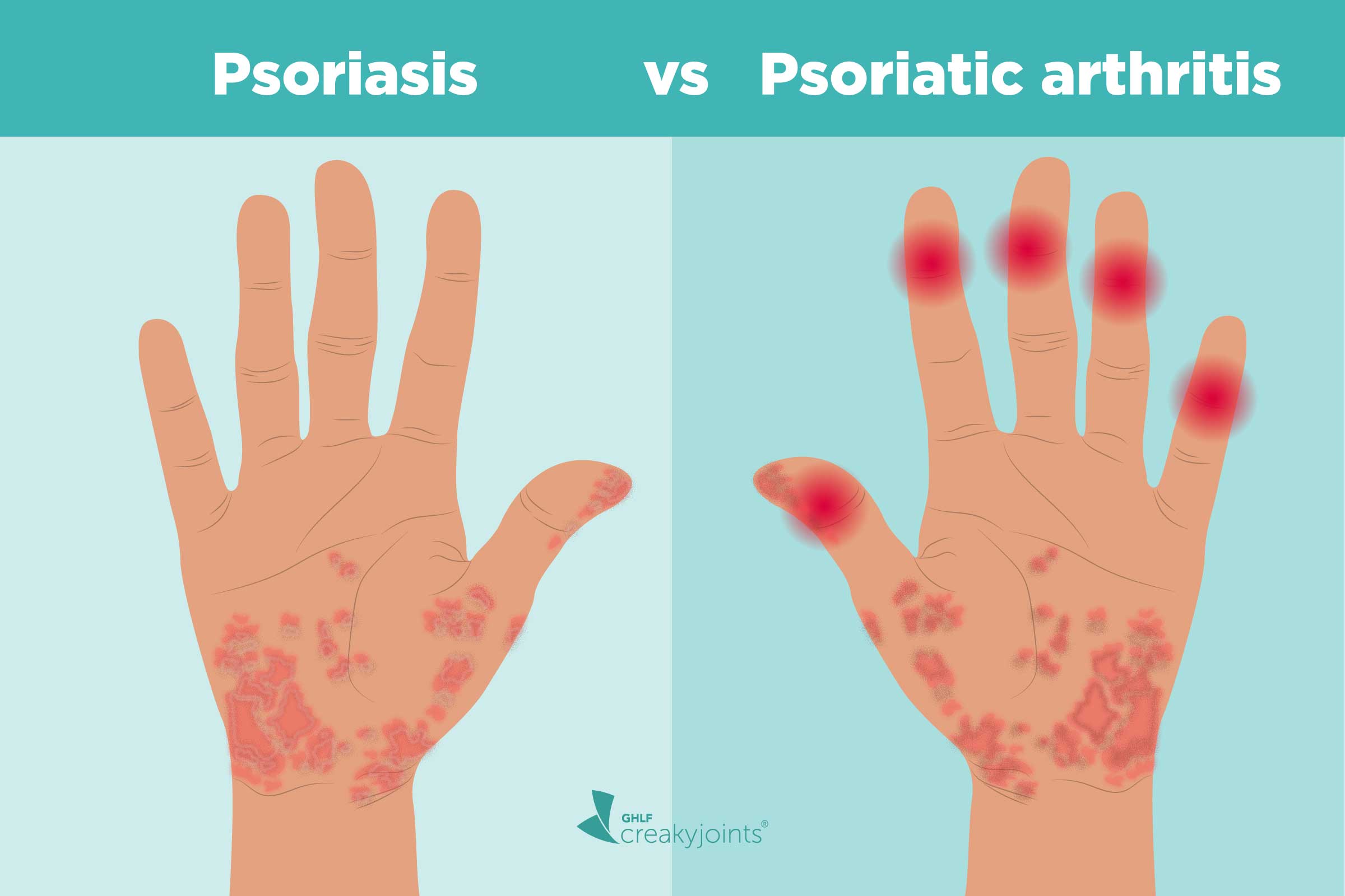 Psoriatic Arthritis