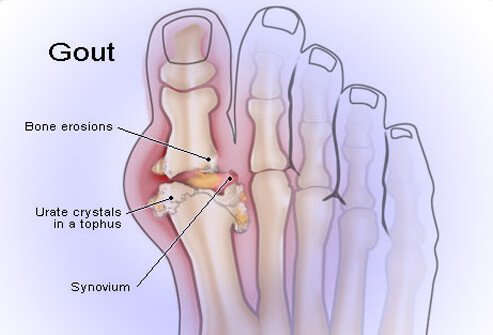 Gout