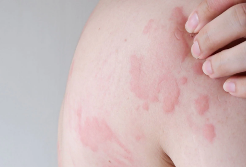 Urticaria